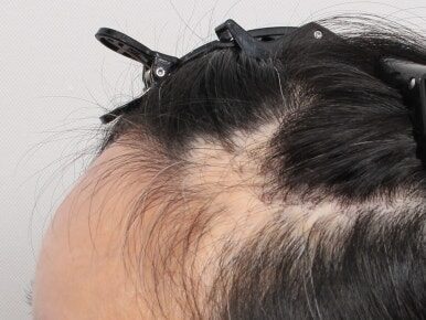Hair Transplants on Scar Tissue: What’s the Actual Survival Rate?