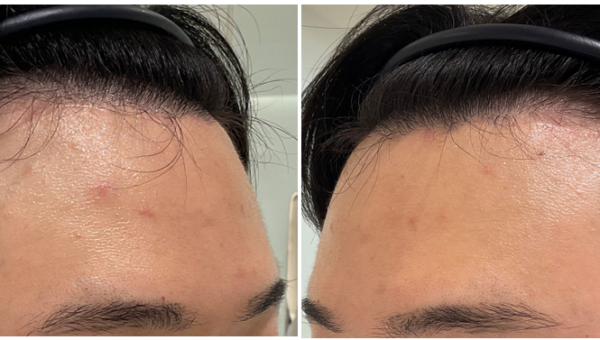 Forehead Reduction for Men: 6-Month Progress Report